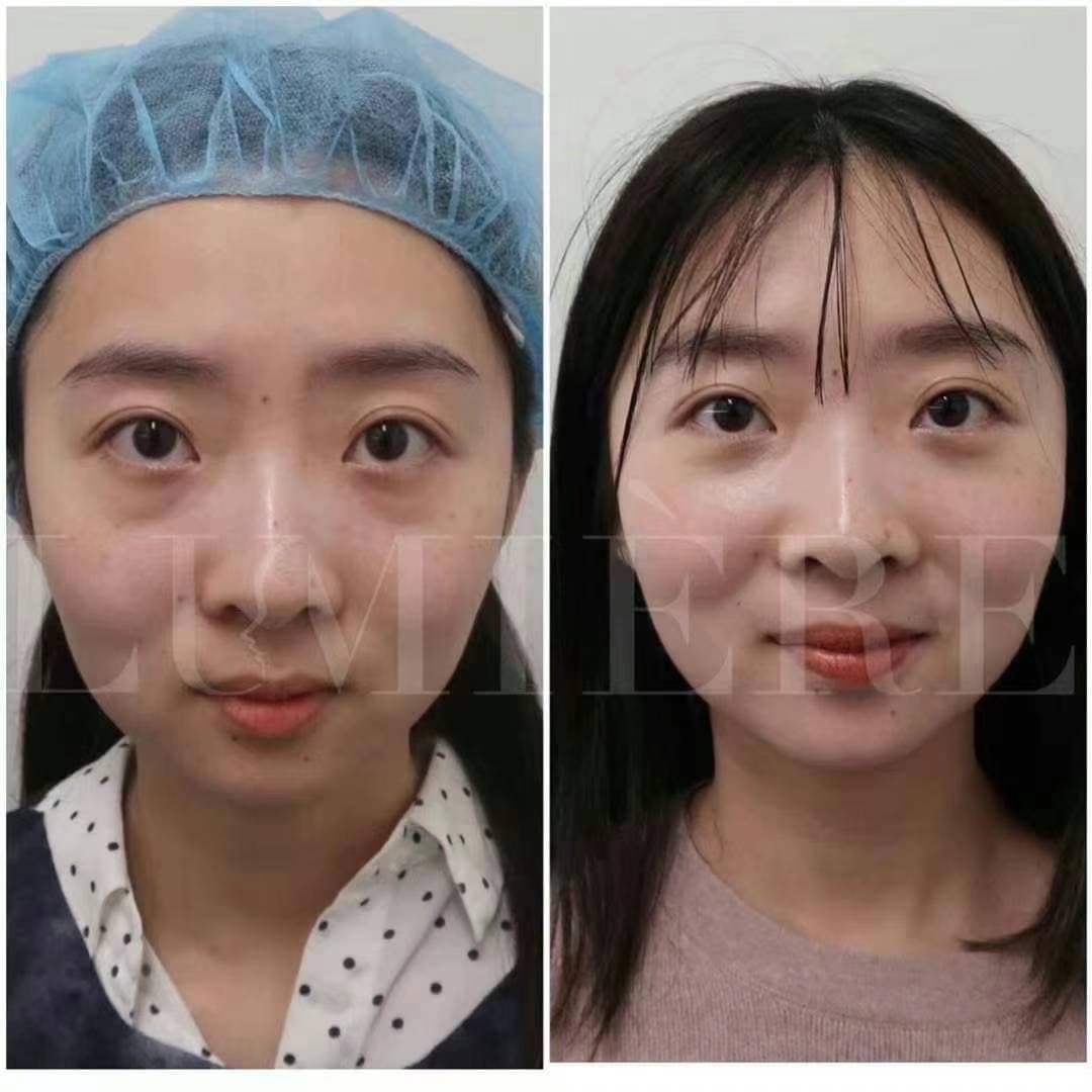 Eye bag removal result - case 2