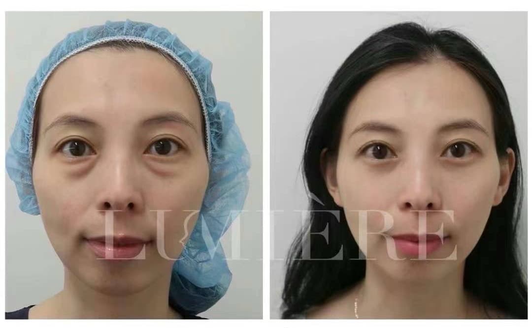 Eye bag removal result - case 3